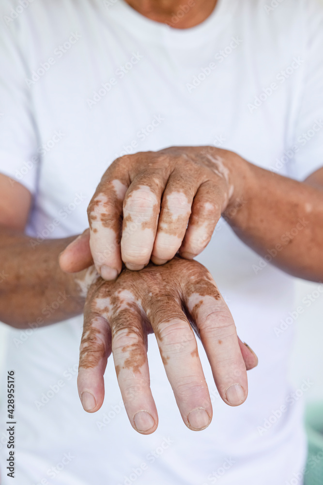 Close-up Vitiligo on skin hands of old people. medical condition causing depigmentation of patches of skin Close-up Vitiligo on skin hands of old people. medical condition causing depigmentation of patches of skin