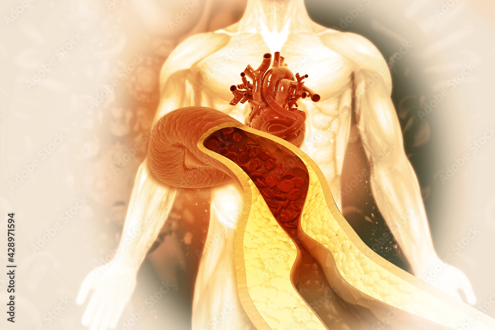 Naklejka premium Cholesterol plaque in artery.3d illustration