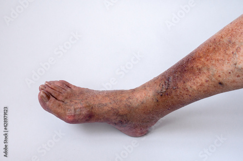 the leg of an elderly woman with varicose veins and its complications. Medical history. Thrombophlebitis