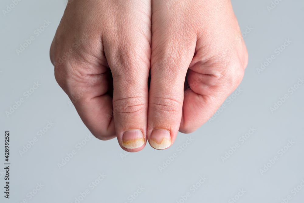 Onychomycosis or fungal nail infection on damaged nails after gel polish, onychosis. Longitudinal ridging nails with psoriasis, nail diseases. Health and beauty problem Onychomycosis or fungal nail infection on damaged nails after gel polish, onychosis. Longitudinal ridging nails with psoriasis, nail diseases. Health and beauty problem