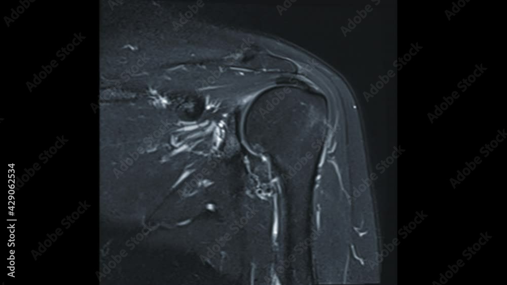 MRI Shoulder joint or resonance imaging of Shoulder Joint
