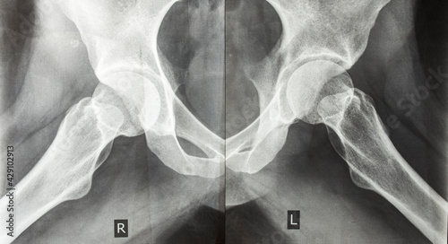 .X-ray picture of human hip joints. Bones x-ray. Traumatology photo