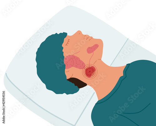 A patient with a diseased submandibular salivary gland. Vector illustration of sialolithiasis. photo