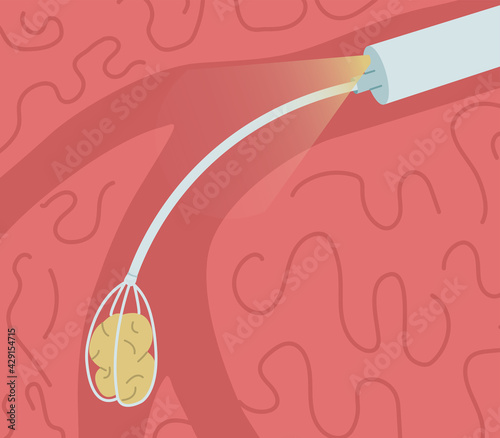 Removal of a stone from the salivary gland duct. Sialendoscopy vector illustration.