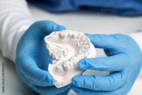 a dentist holds a cast of teeth in his hands in medical gloves for making invisible braces for bruxism, dentures, close-up