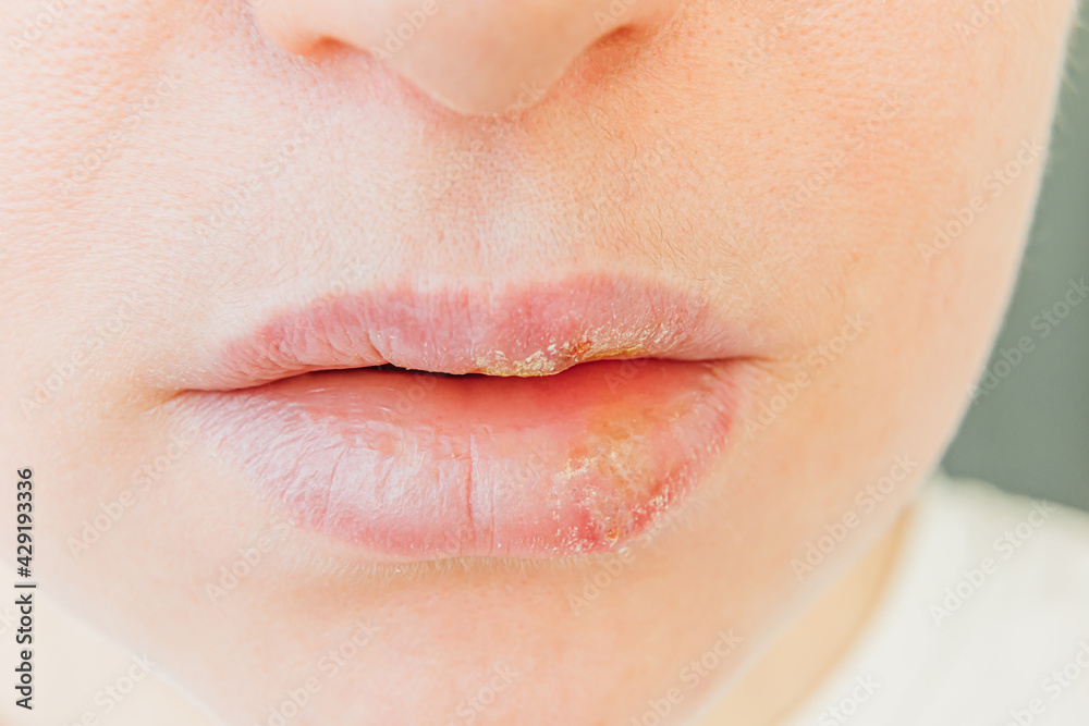 Obraz premium Close up of girl lips affected by herpes. Treatment of herpes infection and virus. Part of young woman face, lips with herpes affected. Beauty dermatology concept.