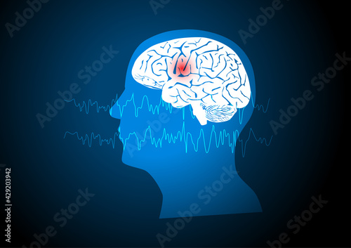 Concepts of human focal seizure or epilepsy