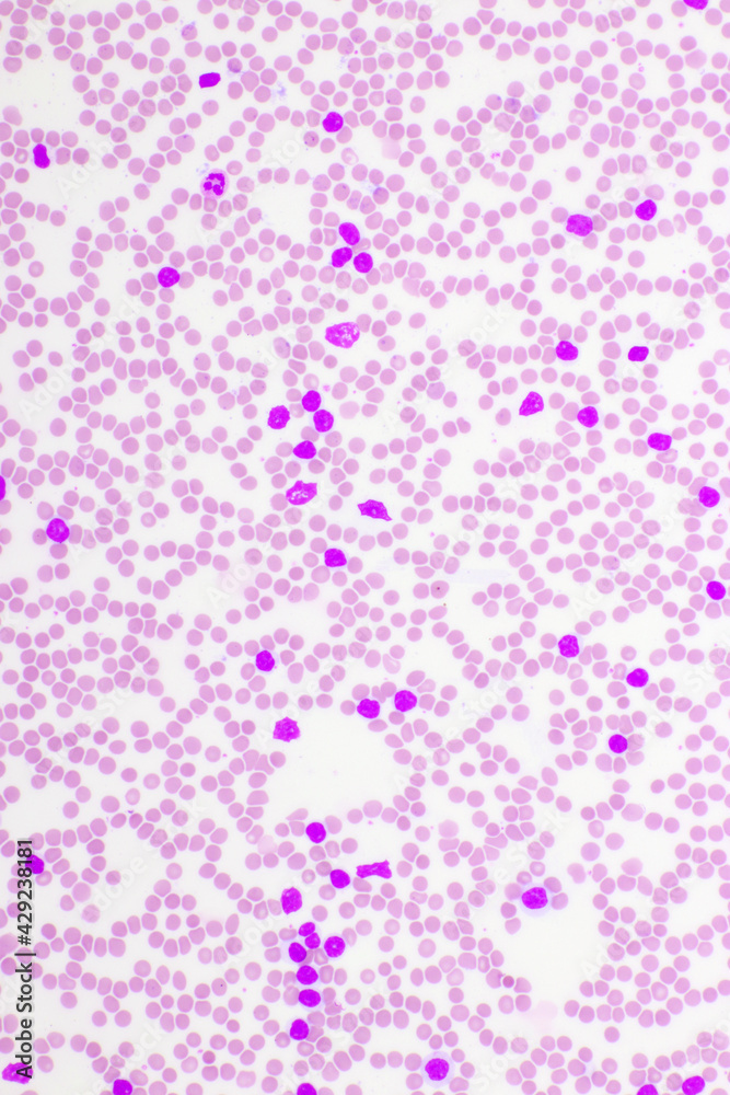 Picture of acute lymphocytic leukemia or ALL cells in blood smear, analyze by microscope, 400x