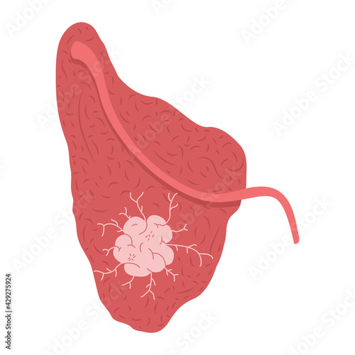 A tumor on the parotid salivary gland. Medical vector illustration.