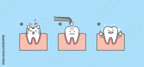 Dental cartoon Step of restoring cavity tooth by filling tooth illustration cartoon character vector design on blue background. Dental care concept.