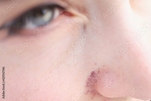 Red cyanotic rash on woman nose closeup photo