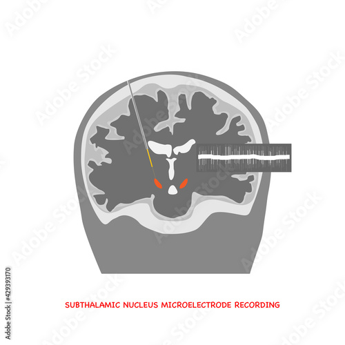 Coronal view Illustration of microelectrode recording of human brain in subthalamic nucleus for Parkinson disease surgery and brain waves.	