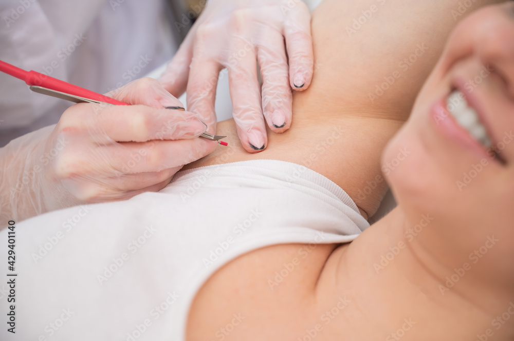 Woman on electro epilation on armpits. Hardware permanent removal of unwanted body hair