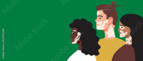 Vitiligo people with depigmentation, copy space template, flat vector stock illustration with man and woman with vitiligo spots on the skin, milanin problem