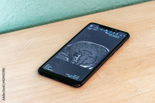 MRI Image of a Human Brain shown on a Smartphone Screen