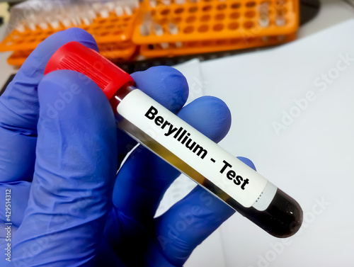 Blood sample for beryllium (heavy metal) test, toxic metal. Diagnosis of beryllium toxicity