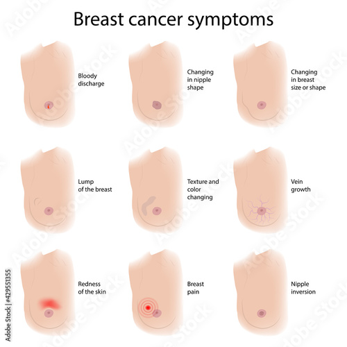 Woman breast. Cancer symptoms. Medical vector illustration.