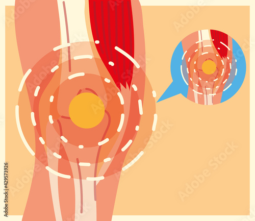 rheumatology leg pain
