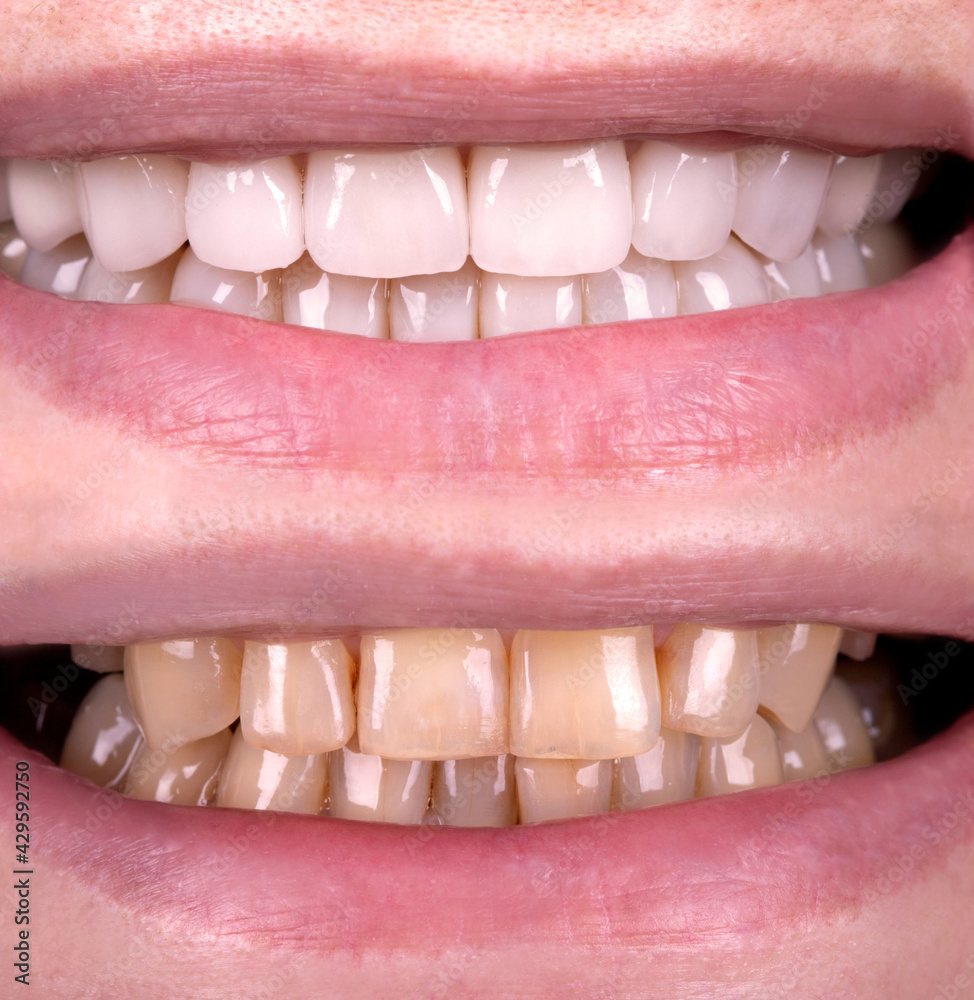 Fototapeta premium Perfect smile before and after veneers bleach of zircon arch ceramic prothesis Implants crowns. Dental restoration treatment clinic patient . Adult old woman surgery procedure whitening dentistry