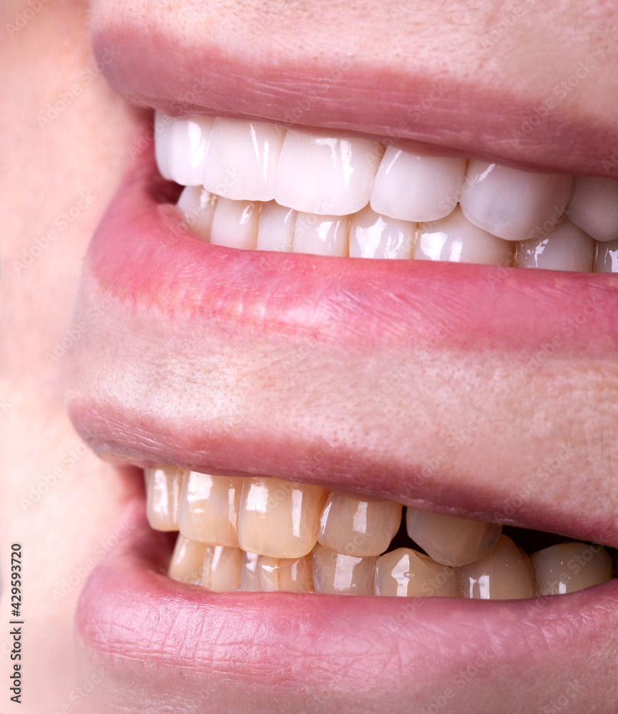 Fototapeta premium Perfect smile before and after veneers bleach of zircon arch ceramic prothesis Implants crowns. Dental restoration treatment clinic patient . Adult old woman surgery procedure whitening dentistry