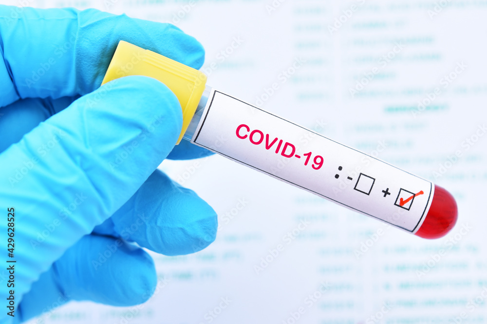 Fototapeta premium Blood sample tube positive with COVID-19 virus