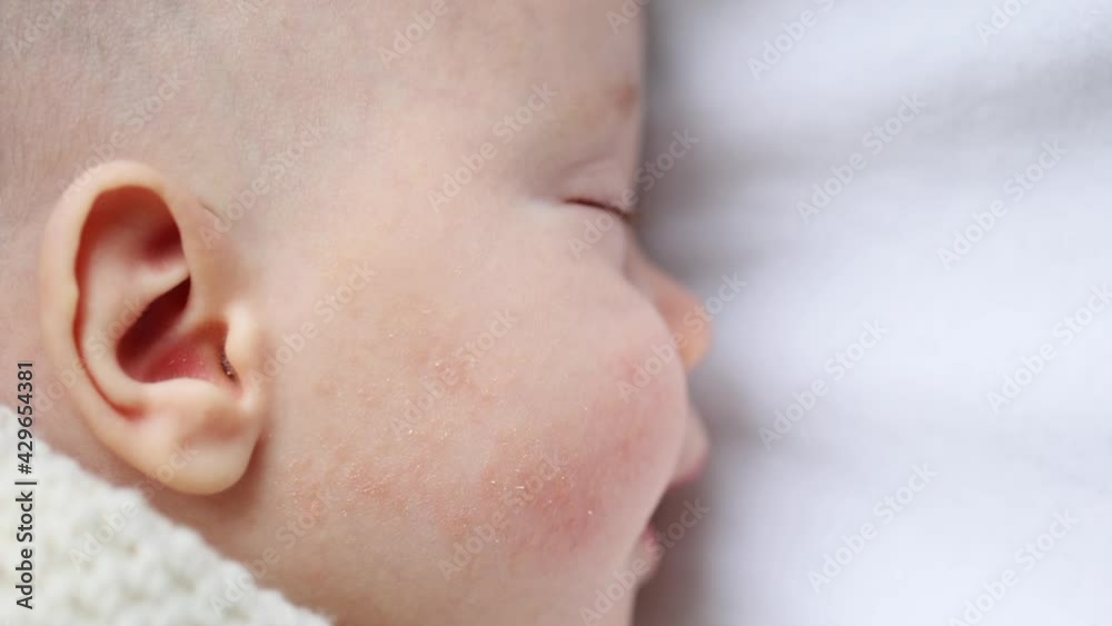 atopic dermatitis allergic skin red rash pimples on baby's cheek face