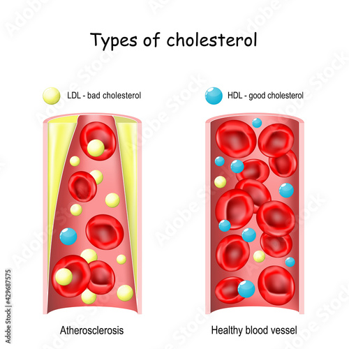 cholesterol. HDL and LDL lipoprotein.