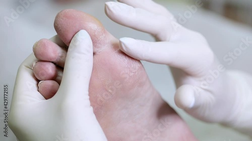 A dermatologist examines the foot of a diabetic patient. Problematic diabetic foot with cracks and scaling. Medical hardware pedicure in the salon. Diseases of the skin.