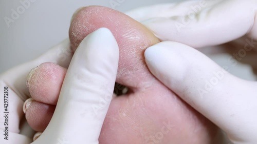 A dermatologist examines the foot of a diabetic patient. Problematic diabetic foot with cracks and scaling. Medical hardware pedicure in the salon. Diseases of the skin.