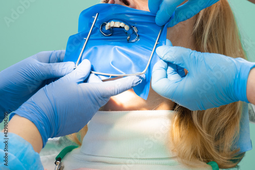 Dental treatment cofferdam in stomatology. Dentist using dental dam for tooth isolation. photo