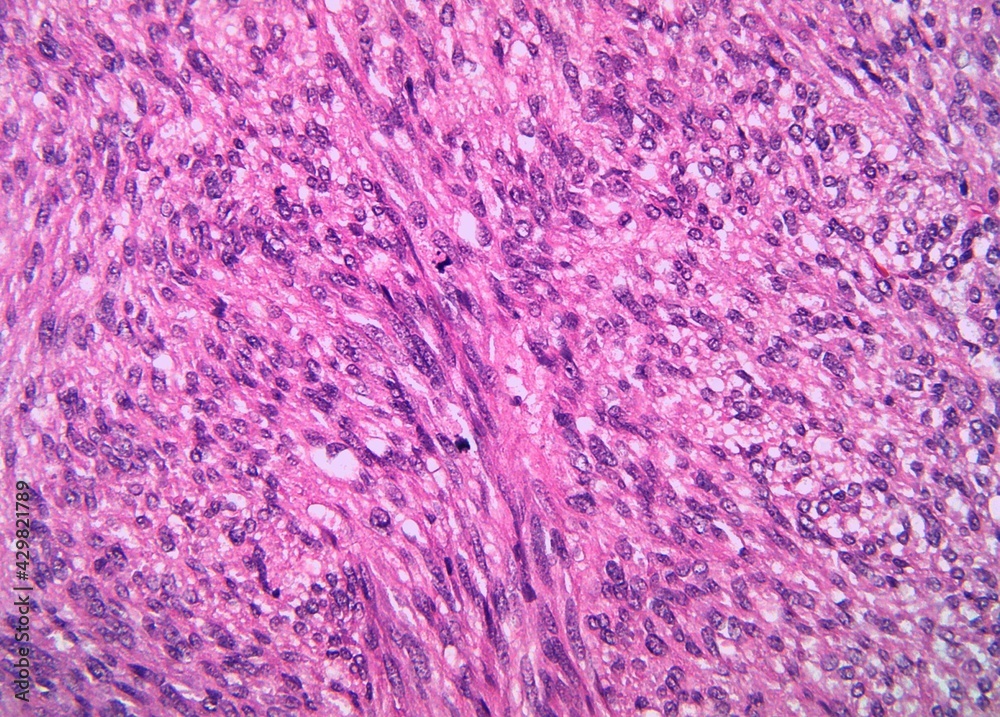 Malignant gastrointestinal stromal tumor or GIST with spindle cells