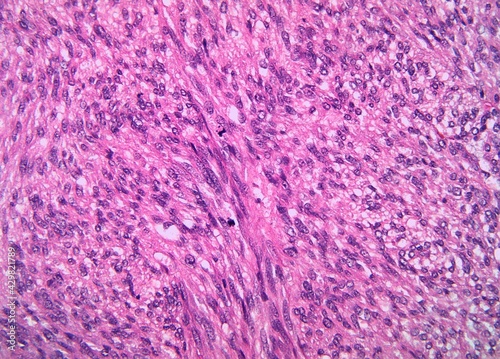 Bild auf Leinwand Malignant gastrointestinal stromal tumor or GIST with spindle cells