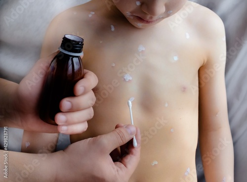 Chickenpox disease, disease therapy with white anti-itch lotion