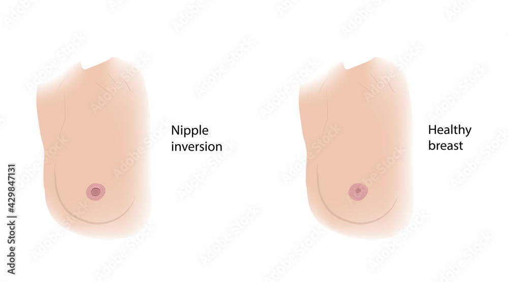 Woman healthy breast and Nipple inversion. Comparison. Medical vector  illustration. Stock Vector