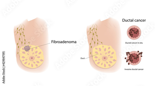 Woman breast. Fibroadenoma and ductal cancer. Comparison. Medical vector illustration.