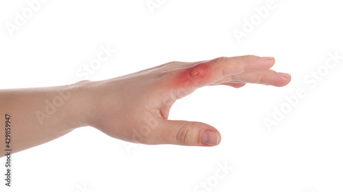 Woman with burn of her hand on white background, closeup