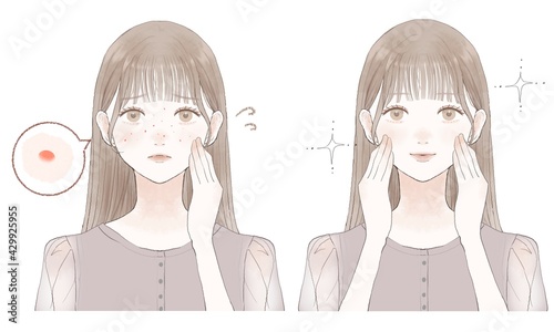 スキンケア　女性　ニキビ　ビフォーアフター