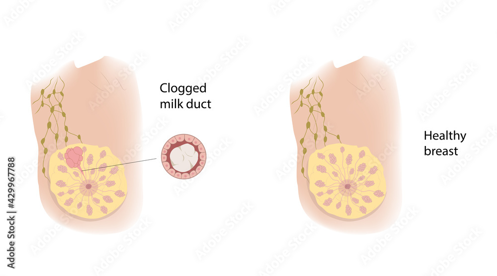 Woman healthy breast and Clogged milk duct. Comparison. Medical vector