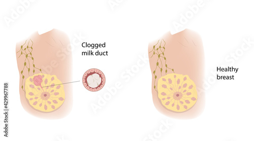 Woman healthy breast and Clogged milk duct. Comparison. Medical vector illustration.