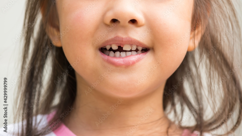 Smilling girl with broken milk tooth by accident Smilling girl with broken milk tooth by accident