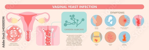 Douche vagina odor clean blood flora ectopic yeast bacterial Pelvic genitals swelling pain sex hygiene system microbes allergic cycle health problem tract prevent mucus Cervical cervix itching cancer