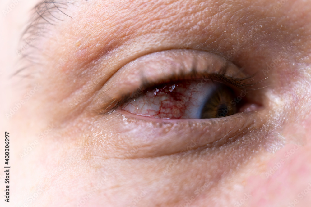 sore eye closeup. Burst blood vessels in the eyeball. Allergic