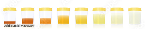 Urine colors, gradations from clear to yellow and orange and even darker, samples in specimen cups with different colored urine -. Indicator of the level of dehydration. Vector on white.
 photo