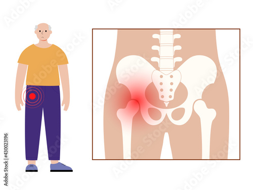 Hip pain and disease