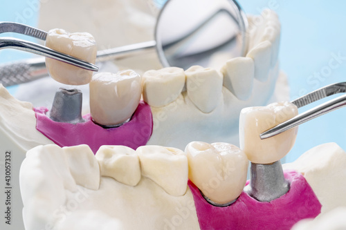 Fototapeta Naklejka Na Ścianę i Meble -  Closeup / Implant Prosthodontics or Prosthetic / Tooth crown and bridge implant dentistry equipment and model express fix restoration.
