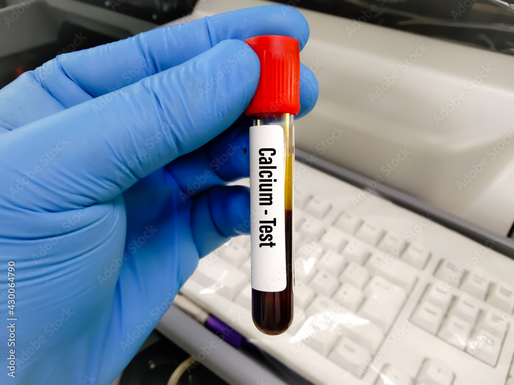Blood sample tube for Calcium test at medical laboratory Stock Photo
