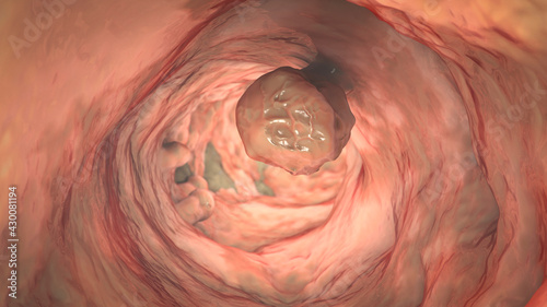 фотографія Bowel polyps, colorectal polyps, 3D illustration