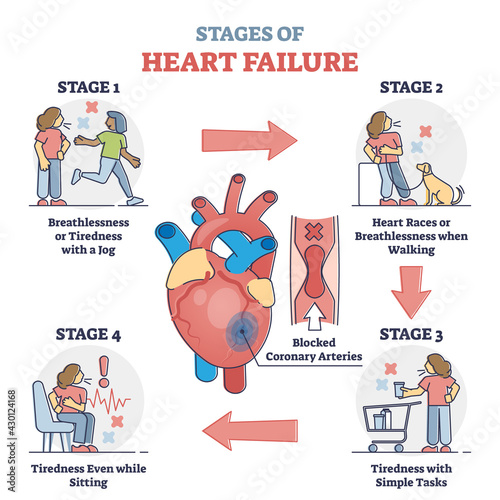Stages of heart failure and symptoms with cardiology stroke outline diagram. Educational labeled guide with medical problem symptoms and cardiac arrhythmia or attack recognition vector illustration.