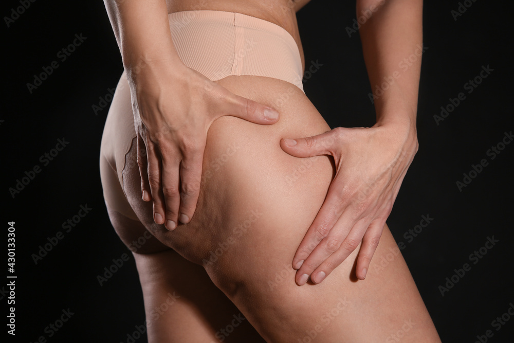 Woman with cellulite on black background, closeup - obrazy, fototapety, plakaty 