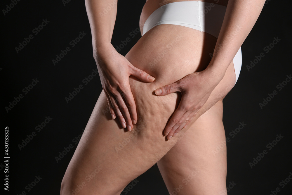 Woman with cellulite on black background, closeup - obrazy, fototapety, plakaty 